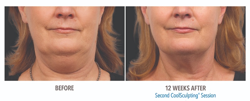 coolsculpting-double-chin-fat-before-and-after-phoenix