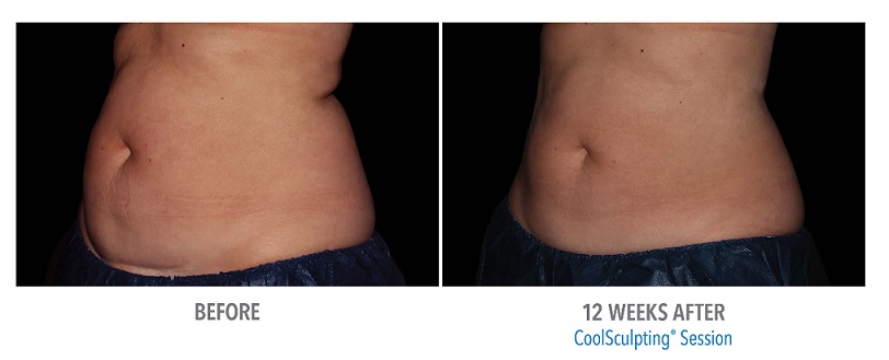 Coolsculpting Belly Fat Results Before and After Photo
