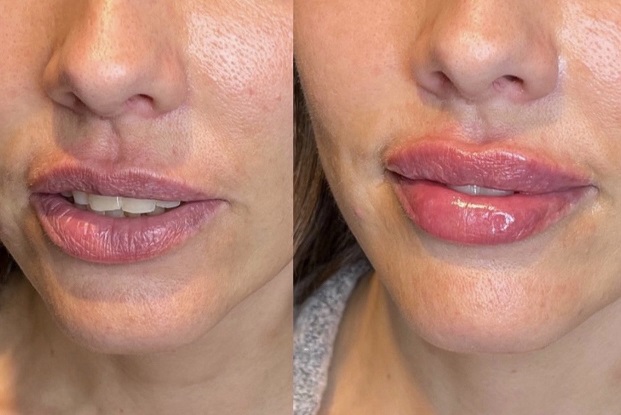 Lip Augmentation Enhancement Treatments - Beverly Hills CA Plastic Surgeon