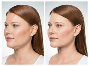 kybella-after-care-instructions