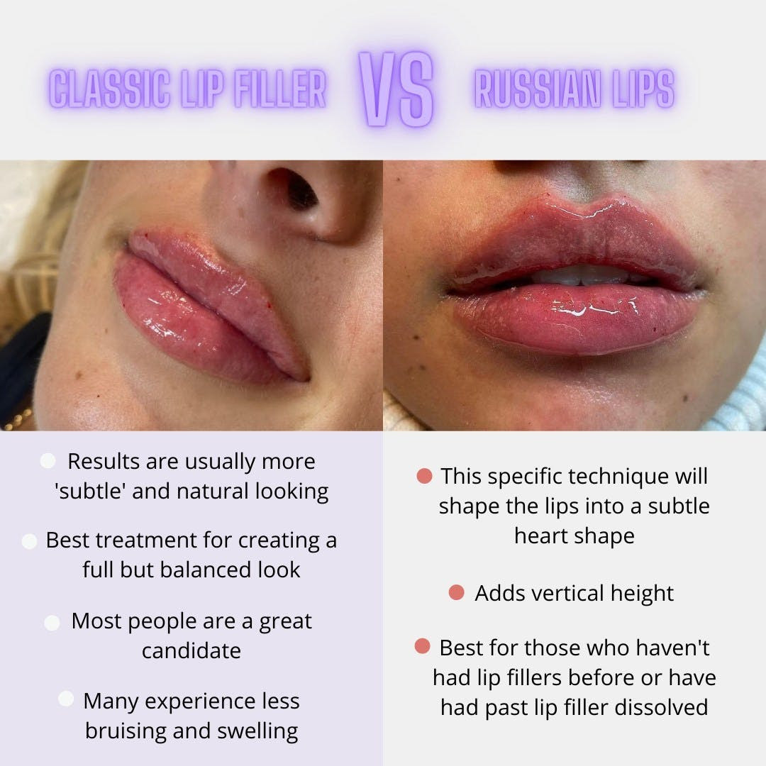 lip-filler-classic-russian-lip-filler-phoenix