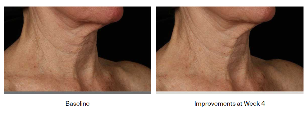 SkinMedica-Neck-Correct-Cream-before-after-photo-1