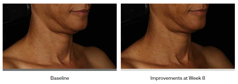 SkinMedica-Neck-Correct-Cream-before-after-photo-2