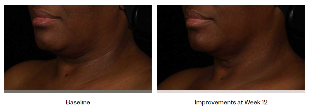 SkinMedica-Neck-Correct-Cream-before-after-photo-3