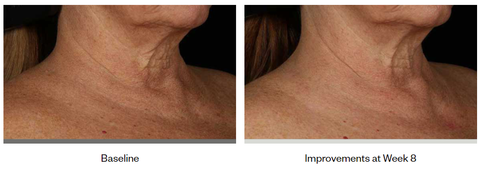 SkinMedica-Neck-Correct-Cream-before-after-photo-4