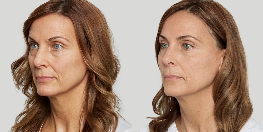 Sculptra-before-after-phoenix