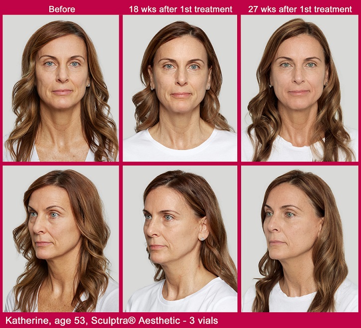 sculptra-before-after-phx