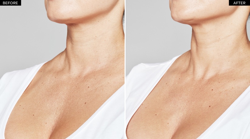 Restylane-SKINBOOSTERS-before-after