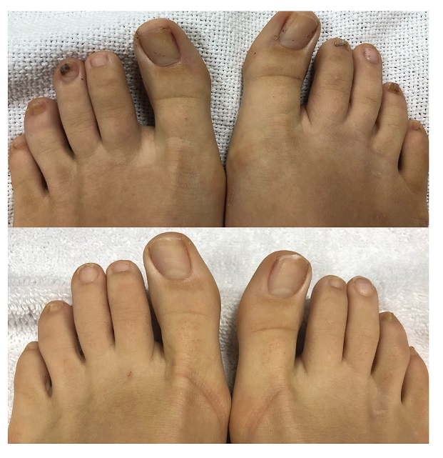 laser-toenail-fungus-removal-phoenix