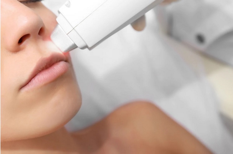 Upper-Lip-Laser-Hair-Removal-Phoenix