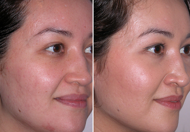 microdermabrasion-phoenix-az