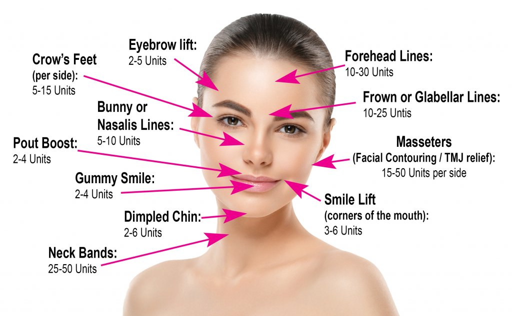chart-botox-units-per-facial-area