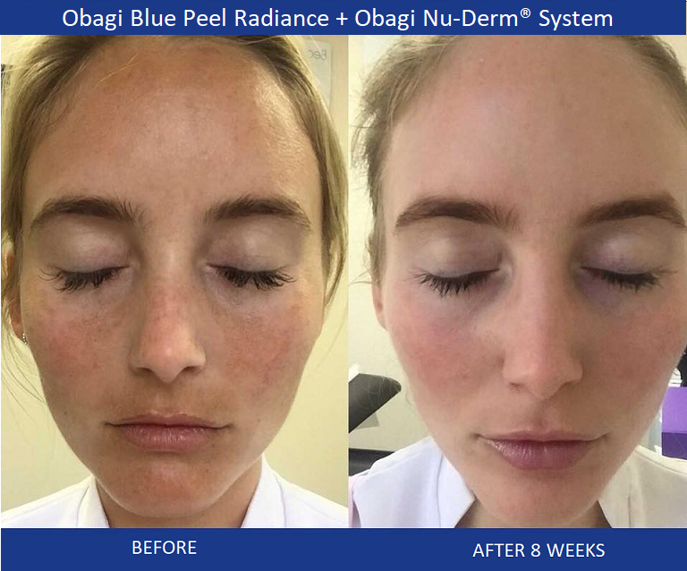 Obagi-Blue-Peel-Radiance-and-Obagi-Nu-Derm-System-Phoenix