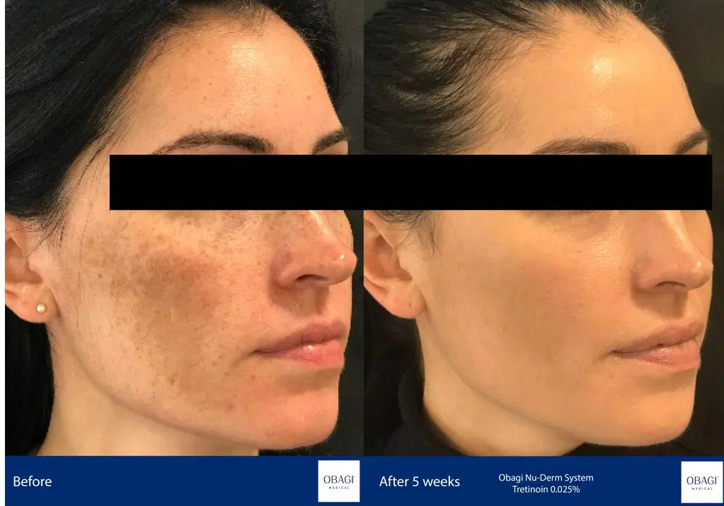 Obagi-Nu-Derm-System-Before-After-Phoenix