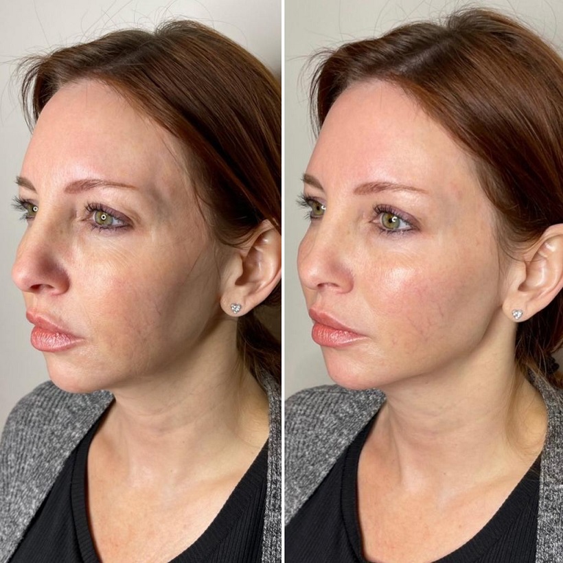 chin-jawline-filler-scottsdale