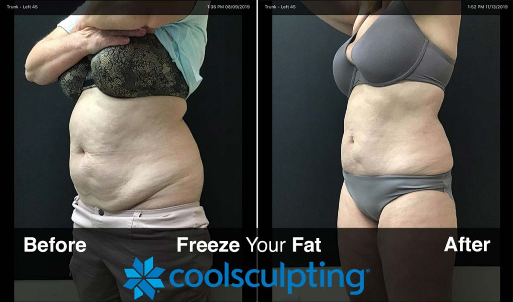 COOLSCULPTING-50% OFF