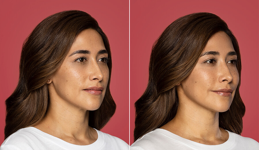 Restylane-Contour-Cheek-Filler-Phoenix