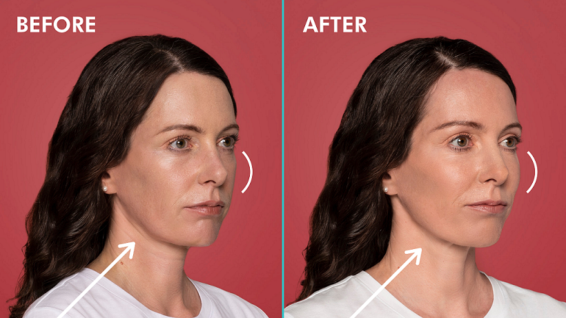 Restylane-Contour-before-after-phoenix