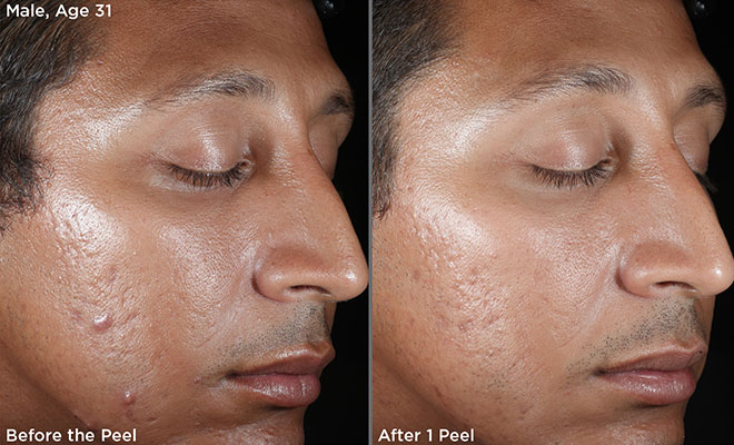 Skinmedica-Vitalize-peel-before-after-phoenix-arizona