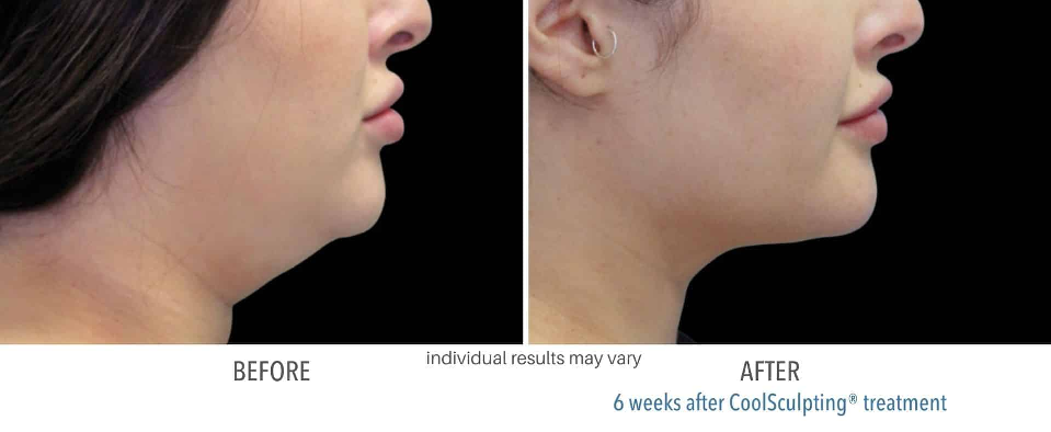 Coolsculpting-Double-Chin-Fat-Phoenix