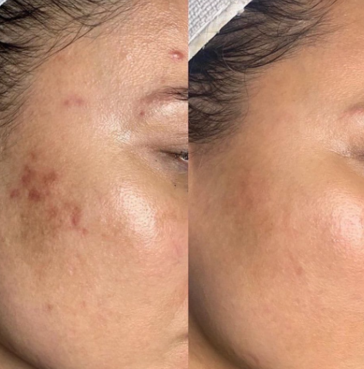 SkinPen MicroNeedling + Exosomes (Face)