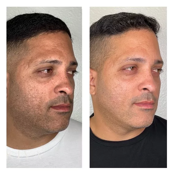 SkinPen-MicroNeedling-Phoenix-Arizona-1