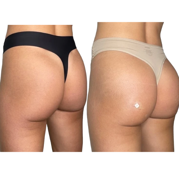 Non-Surgical ButtLift BBL Injection