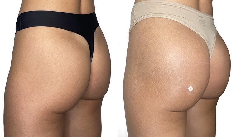 Radiesse-buttlift-bbl-phoenix-1