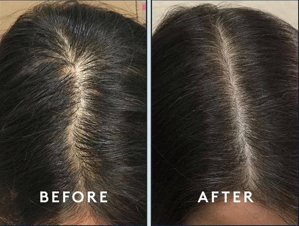 PRP & Exosome Hair Restoration