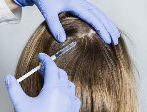prp-hair-loss
