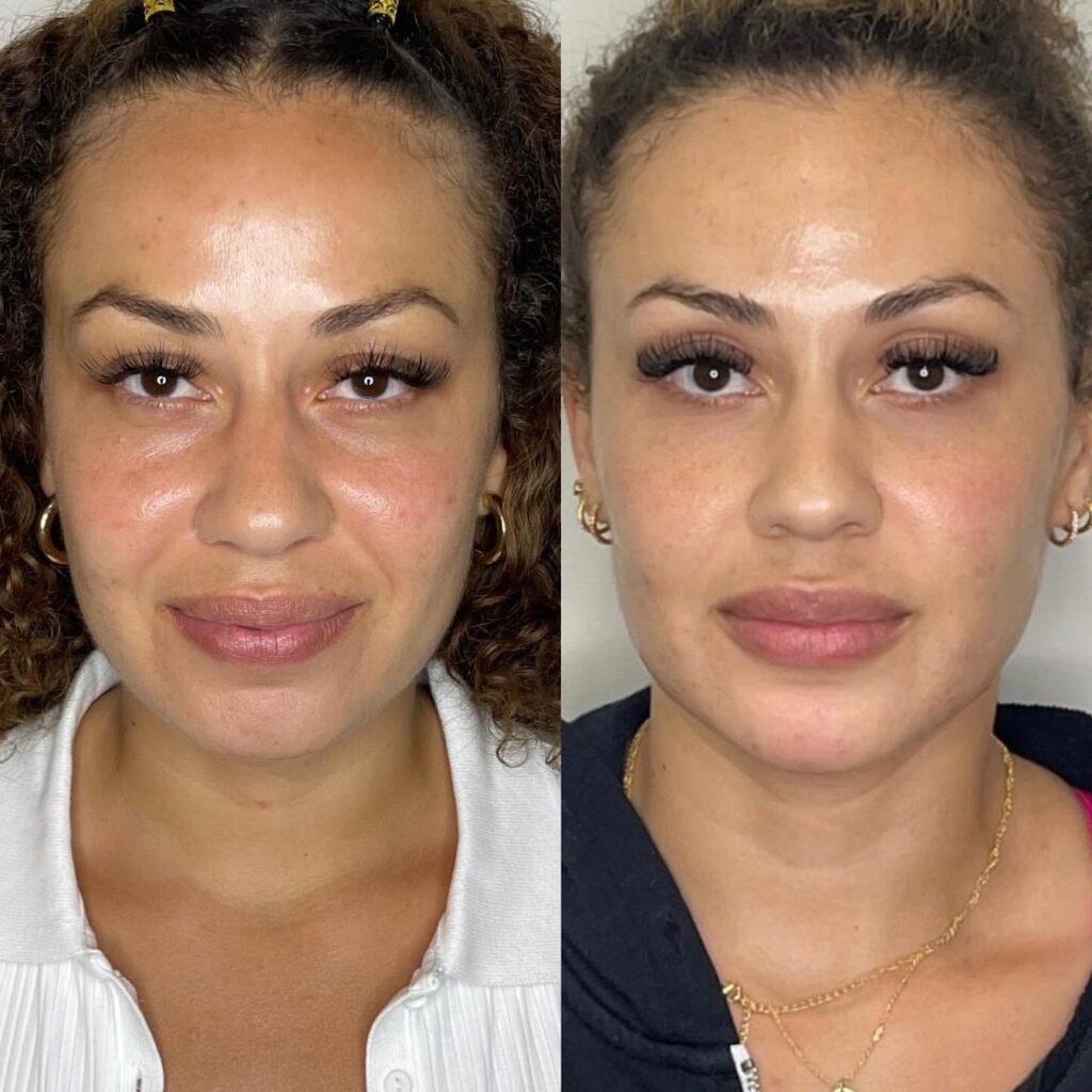 Jawline-Filler-Contouring-Phoenix-1