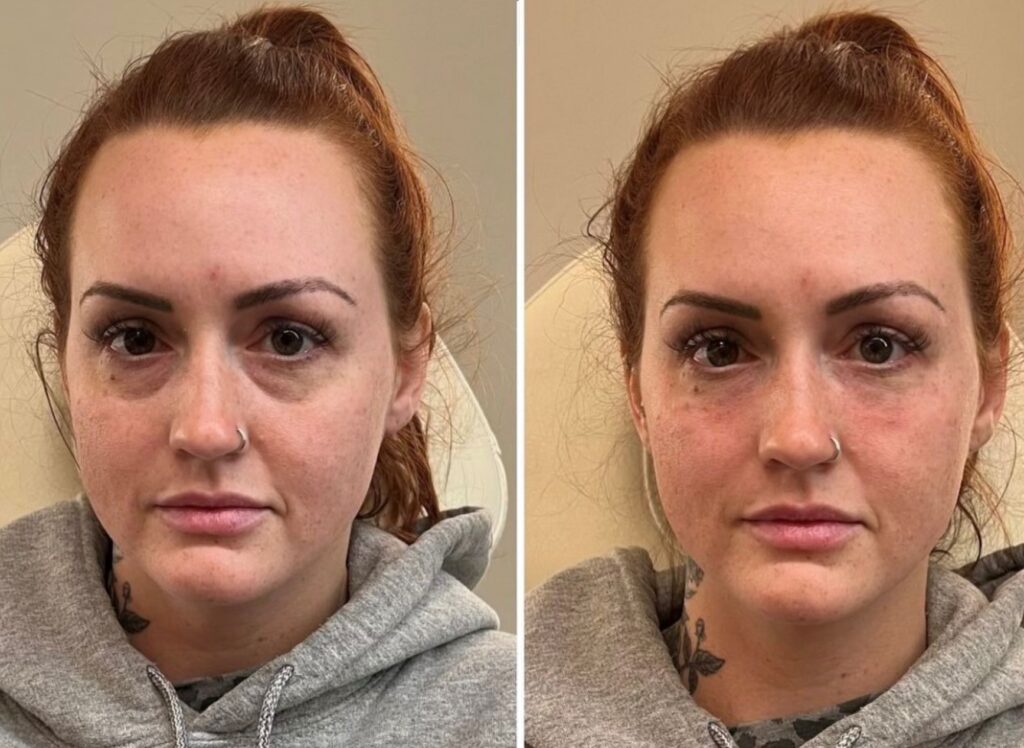 Restylane-EYELIGHT-Under-Eyes-Filler