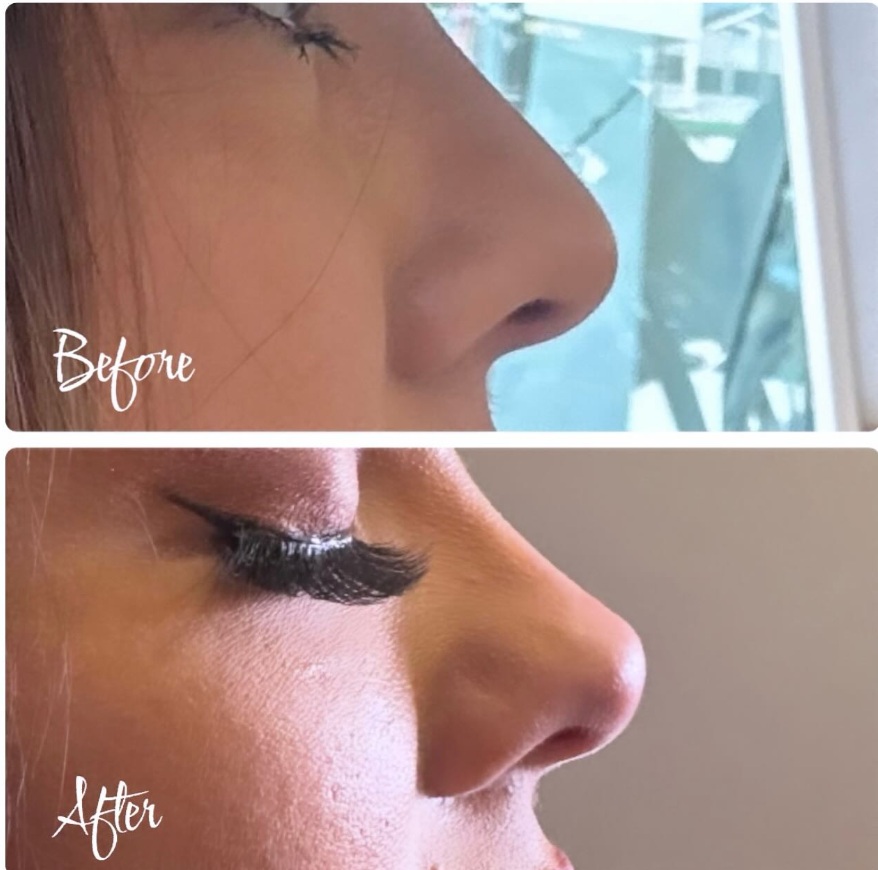 botox-Tinkerbell-nose-tip-lift