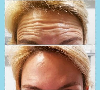 botox-phx