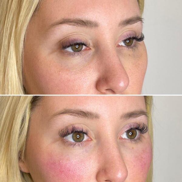 under-eyes-filler-arcadia-phoenix