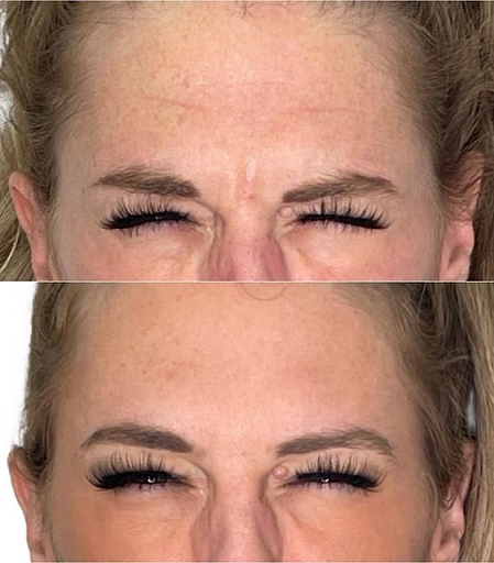 dysport-arcadia-phoenix-az