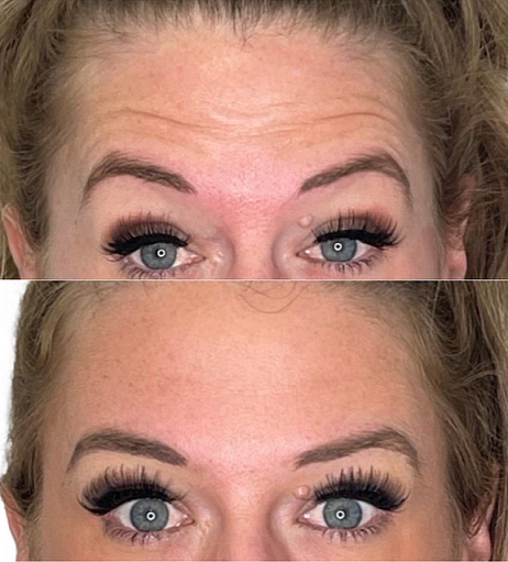 dysport-arcadia-phoenix-az