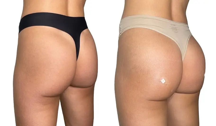 How much does a non-surgical buttock augmentation typically cost?
