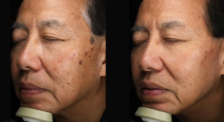 Picofy-laser-before-after