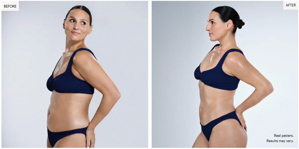 Coolsculpting Real results from real patients