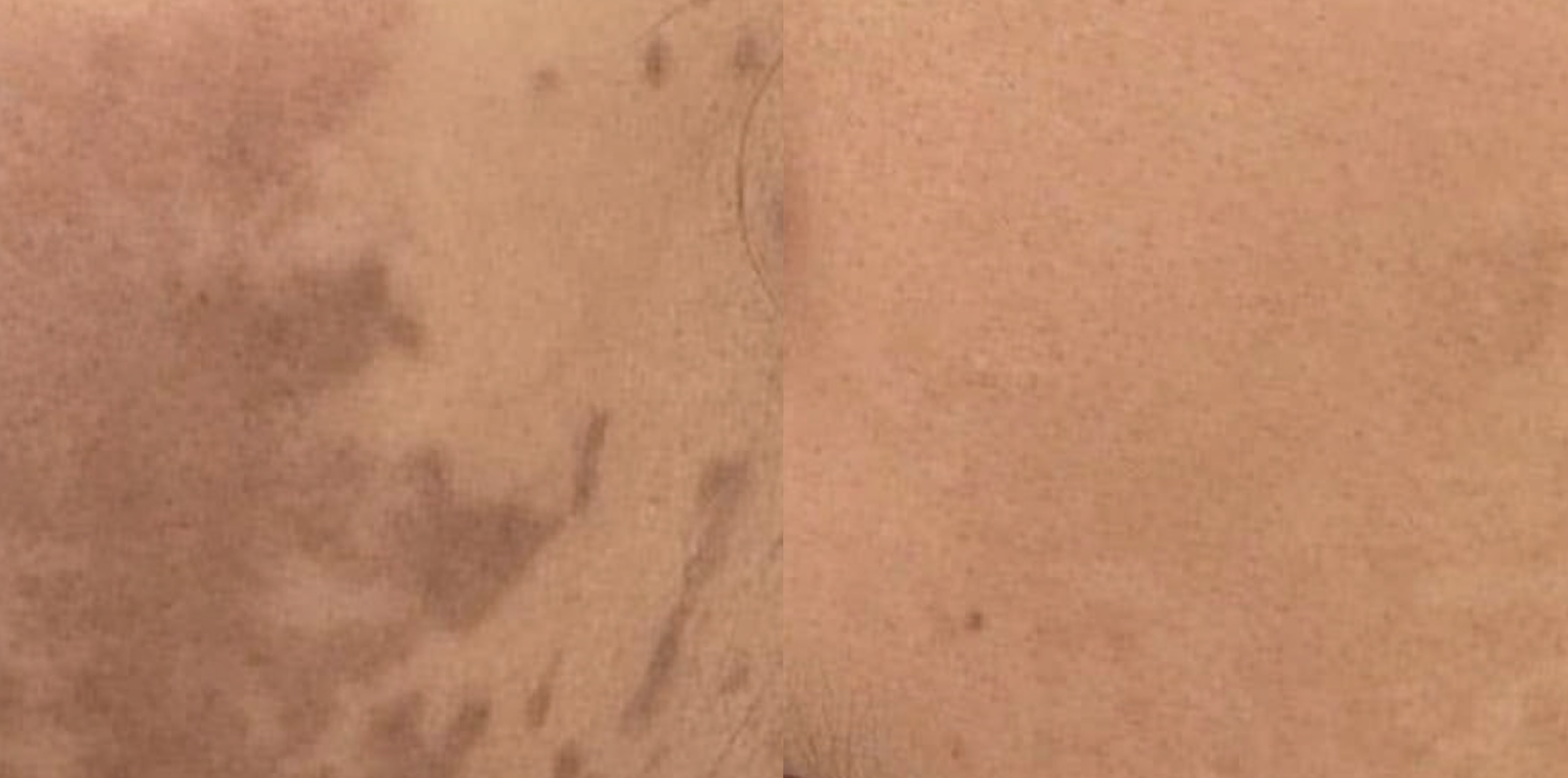 PicoFy Laser Before & After at Suddenly Slimmer Med Spa, Arcadia, Phoenix, AZ