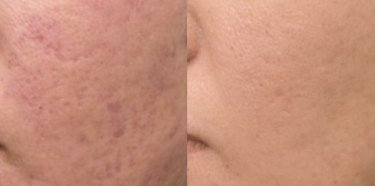 PicoFy Laser Before & After at Suddenly Slimmer Med Spa, Arcadia, Phoenix, AZ
