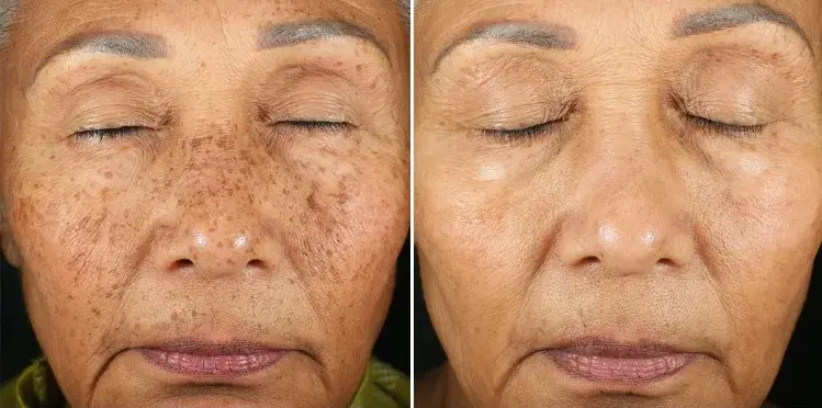 PicoFy Laser Before & After at Suddenly Slimmer Med Spa, Arcadia, Phoenix, AZ