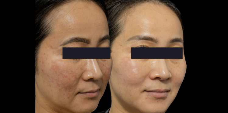 PicoFy Laser Melasma Treatment at Suddenly Slimmer Med Spa Arcadia, Phoenix 3