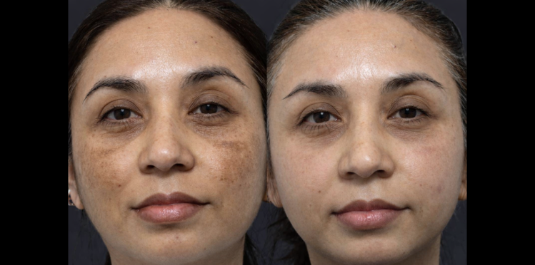 PicoFy Laser Treatment for Melasma at Suddenly Slimmer Med Spa in Arcadia, Phoenix