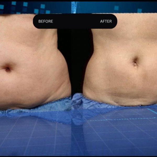 Before After