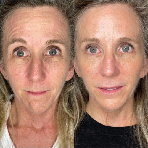 Juvederm Ultra XC