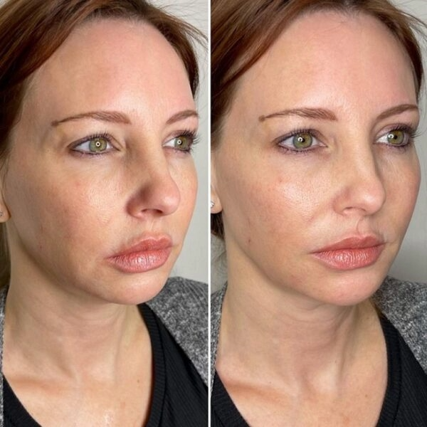Juvederm Ultra XC