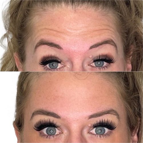 botox-before-after-5